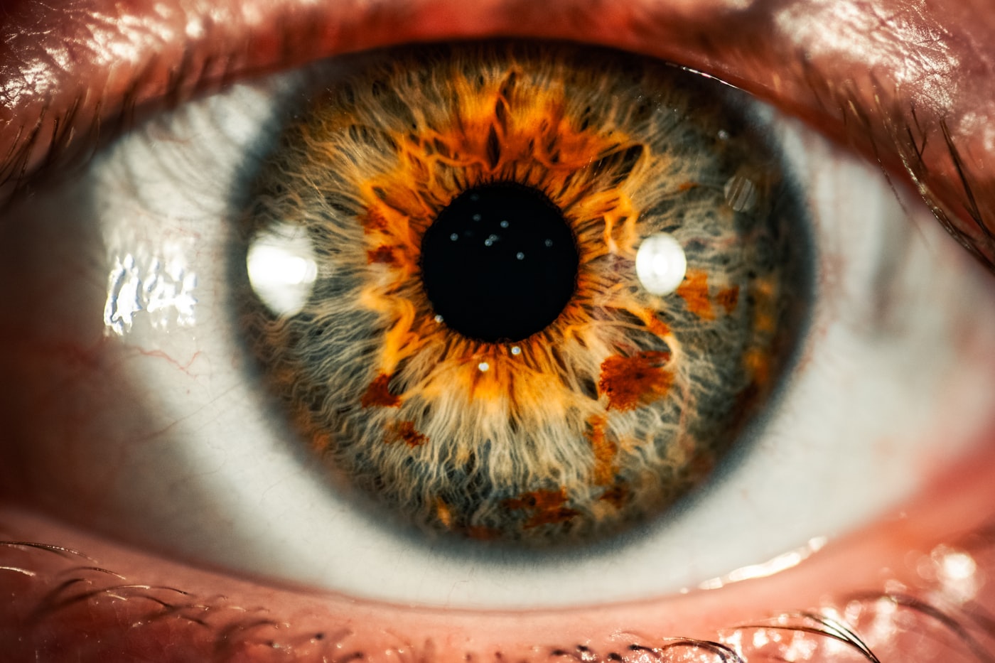 Eye Allergy